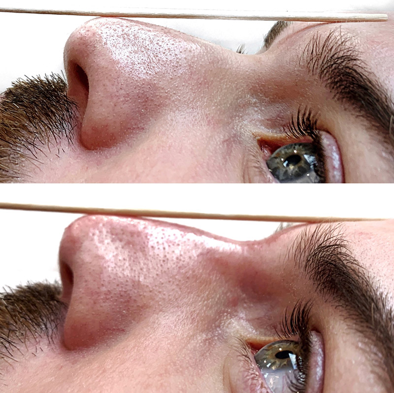 Non Surgical Rhinoplasty