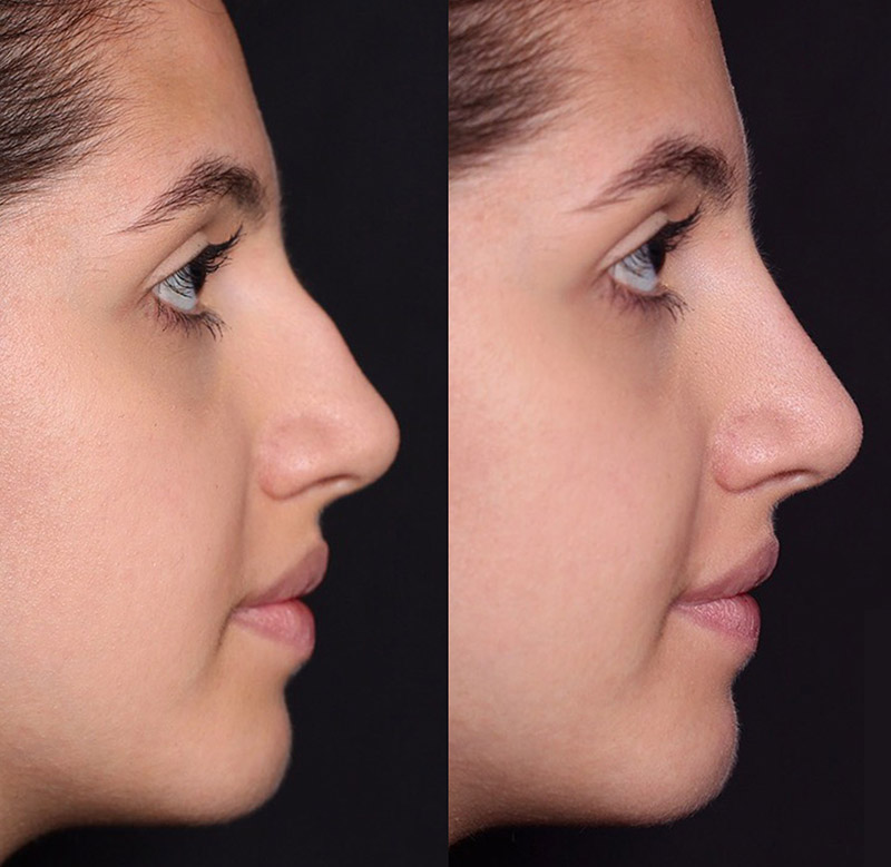 Non Surgical Rhinoplasty