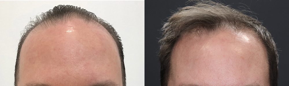 Prp Hair Restoration
