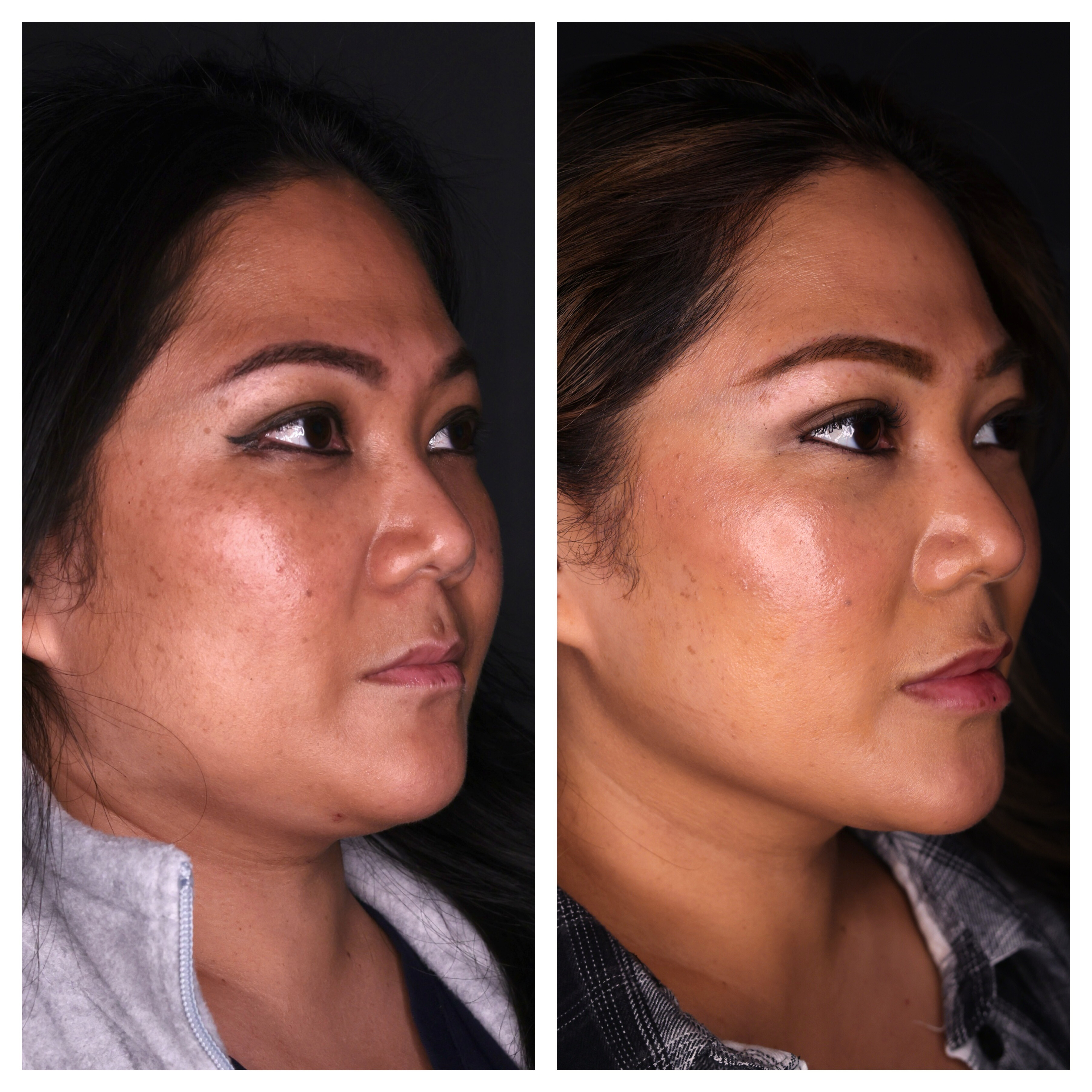 Botox Before and After | Kaado MD Aesthetics & Anti-Aging Medicine