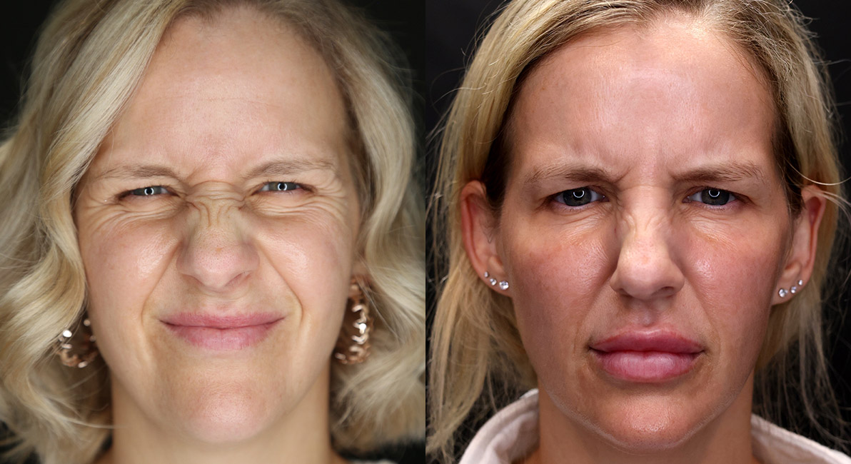 Botox Before and After | Kaado MD Aesthetics & Anti-Aging Medicine
