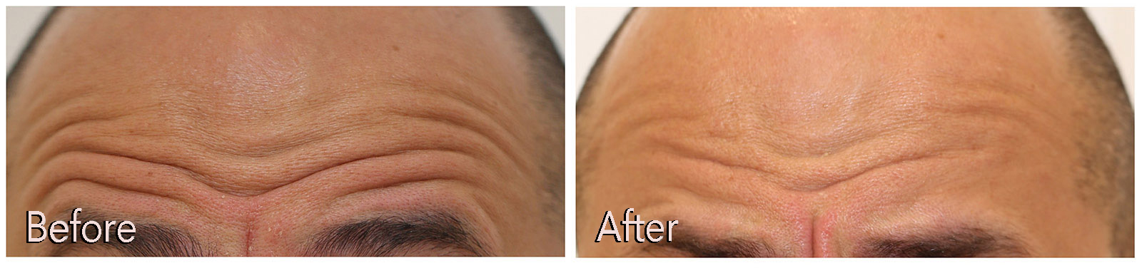Botox Before and After | Kaado MD Aesthetics & Anti-Aging Medicine