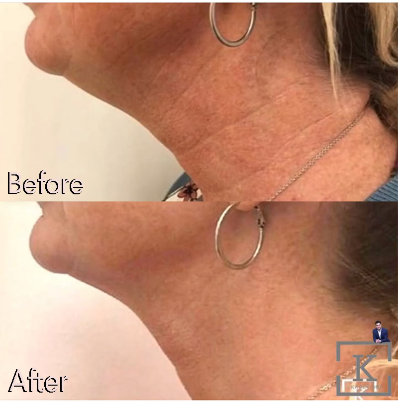 Botox Before and After | Kaado MD Aesthetics & Anti-Aging Medicine